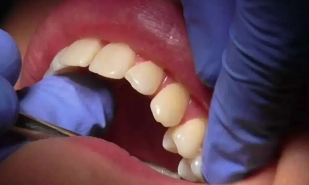 العناية بـ الأسنان وترميمها ليست مسألة تجميلية فقط، بل قد تكون عاملًا مهمًا في إطالة العمر 