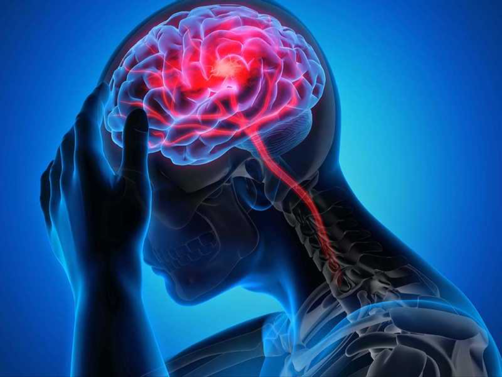 تطوير علاج جديد لحماية الدماغ بعد السكتة الدماغية 